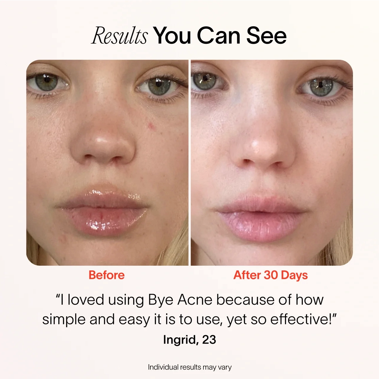 Bye Acne: 3-Minute Pimple Spot Treatment